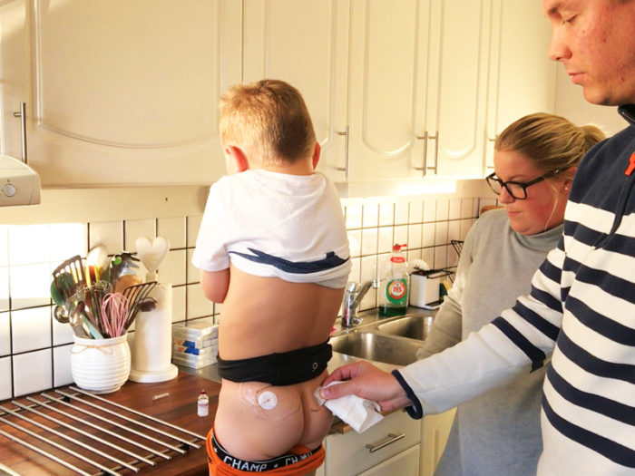 Theo Stenlundh, Emelie Stenlundh och Patrik Stenlundh gör sig redo för att byta nålen till Theos insulinpump. Diabetes typ 1, barn.